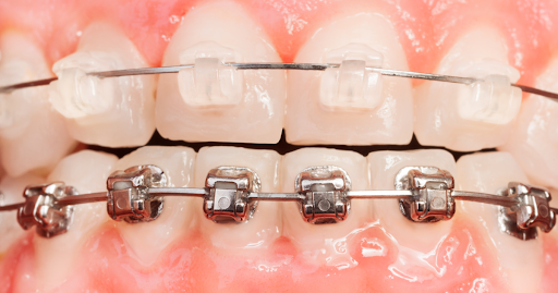 /blog/Ceramic Braces vs Metal Braces Which is Better for You 1